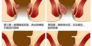 梦见长痔疮预兆 治痔疮最快最好最有效的方法缩略图