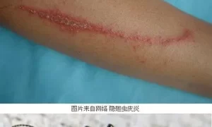 做梦腿上有很多长虫子 做梦梦到一堆虫子缩略图